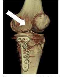 This is associated with a positive bone scan and, frequently, a radiolucent lesion in the subchondral zone. Figure 3 From Impingement Between Medial Plica Against Femoral Condyle Osteophyte After High Tibial Osteotomy Semantic Scholar