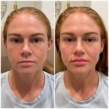 Ashley Ferguson Head MSN, FNP-C (@ashley.fineline.aesthetics) • Instagram  photos and videos