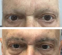 My ferritin was down to 40 so i was put on ferrous sulphate. Steroid Injections Hair Center Serbia