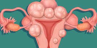 Stomach cancer is usually asymptomatic early on, or causes vague symptoms like bloating, indigestion, and a feeling of fullness in the upper abdomen. Women Are Now Posting Photos Of Their Uterine Fibroids All Over Reddit Women S Health