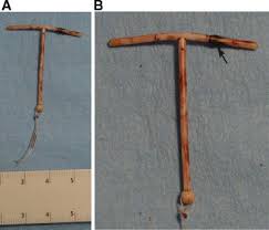 The iud is a popular choice of contraception for many women and can protect against pregnancy for five to 10 years. Long Term Indwelling Copper Intrauterine Device Iud Found During Primary Infertility Work Up Sciencedirect