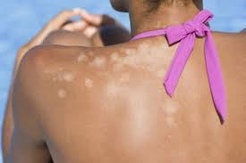 Remove The White Skin Spots Easy And Fast White Skin Spots Skin Spots Natural Skin Tightening