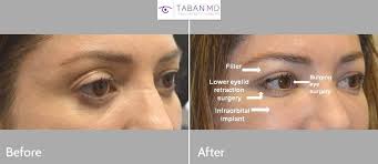First 2 days patients should avoid make up, cleansers, scrubs and apply only antiseptic cream twice a day. Before And After Canthoplasty Photos Mehryar Ray Taban Md