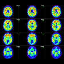 New Research Reveals Donanemab, an Alzheimer's Drug, Demonstrates Mildly Slowing Memory Decline - 1