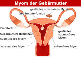 Myom Der Gebarmutter Uterusmyom Citypraxen Berlin
