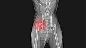 Surgery occurs with general anesthesia and may include maneuvering their hip into the socket, which is called a closed reduction. Coxofemoral Luxation Diagnosis And Reduction Upstatevet Com