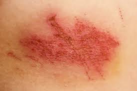 Image result for Impetigo
