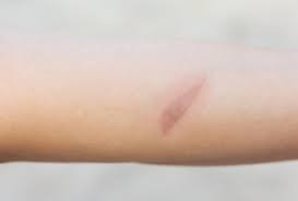 Maybe you would like to learn more about one of these? Minor Burns Causes And Medical Treatment Emedihealth