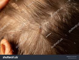 Image result for dry scabs on the head in children
