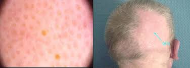 Dogs with alimentary lymphoma, which affects the intestines, may present with vomiting, abdominal pain, anorexia, diarrhea, and weight loss. Cicatricial Alopecia Related To Folliculotropic Mycosis Fungoides Springerlink