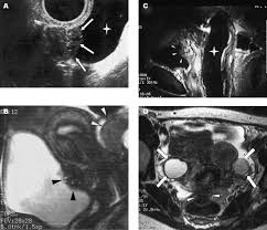 Diagnostic radiology residents and attending radiologists are the target audience for this educational exhibit. Comparison Of Magnetic Resonance Imaging And Transvaginal Ultrasonography In Diagnosing Bladder Endometriosis The Journal Of The American Association Of Gynecologic Laparoscopists
