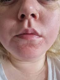 So I just realized my dermatologist prescribed me clindamycin again, but  it's not a gel it's a a topical solution. To the people who have been  prescribed this, how do you put