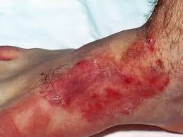 Image result for penis mycosis symptoms