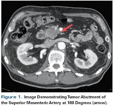 Ct scan for pancreatic cancer. New Treatment Options And Management Considerations In Borderline Resectable Pancreatic Cancer