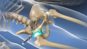 Image result for Joint Injection