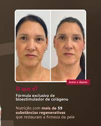 Rejuvenescimento 50+ Recupere a sua juventude, tratando sua pele de dentro  para fora. Método de Rejuvenescimento que vai devolver a tua autoestima,  tratando o envelhecimento e te deixando mais Jovem. Não é