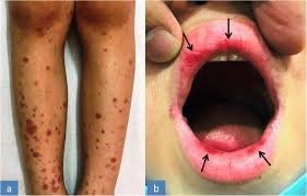 Concomitant bullae, vesicles, petechiae, and ulcerative targoid lesions may also be present. Purpuric Lip Lesions In A Young Boy With Iga Vasculitis Springerlink