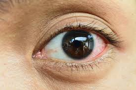 Cara menyembuhkan mata merah dengan aye care softgel. Ketahui Seputar Jenis Pengobatan Dan Pencegahan Sakit Mata Menular Alodokter