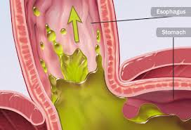 Ginger drink is good when you have acid reflux. Foods That Fight Gerd