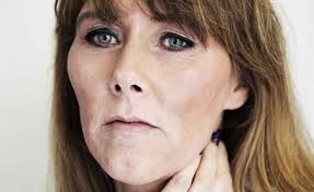 47-årige Anja taler stofbrugernes sag: Jeg lever et godt liv med metadon