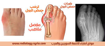 مرض النقرس داء الملوك أطباء الأشعة السوريون والعرب صحة عامة