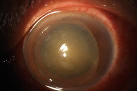 Image result for Lens Dislocation