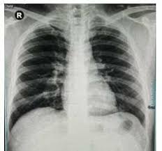 Image result for Chest XRay
