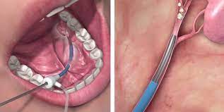 The procedure allows the ear, nose and throat (ent) specialists at nebraska medicine to treat a variety of conditions of the salivary glands without surgery. Cook Medical Sialendoscopy And Salivary Stone Removal Medmovie Com