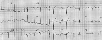 Image result for Left Axis Deviation