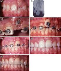 Maybe you would like to learn more about one of these? Clinical Recommendations For Management Of Mesiodens And Unerupted Permanent Maxillary Central Incisors Springerlink
