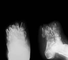 Image result for toe amputation