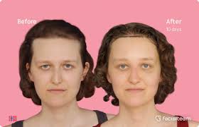 Facial Exercises for FFS Recovery — Facialteam