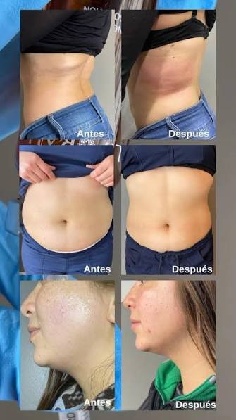 Ya es oficial!! , 1 5 % o f f ‼️en quemadores inyectables‼️, Incluye: 1  sesión en una zona + radiofrecuencia , Zonas : Papada, brazos, pliegues  axilares, cadera, abdomen, interior o exterior de los ...