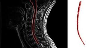 Diagnosticarea sclerozei multiple se face cu usurinta, sau poate fi confundata cu alte boli neurologice? SclerozÄƒ MultiplÄƒ Stiri Despre SclerozÄƒ MultiplÄƒ 360medical Ro