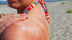 A sunscreen allergy rash may occur wherever on the body where it was applied almost immediately, or it could show itself several hours later. How To Tell If You Re Allergic To Sunscreen Everydayhealth Com