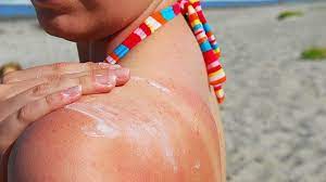 There are a couple of signs that will help a person realize he or she is allergic to sunscreen like swelling, itching, reddened skin and blisters. How To Tell If You Re Allergic To Sunscreen Everydayhealth Com