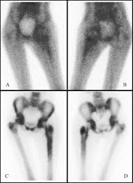 Image result for Osteomyelitis Bone Scan