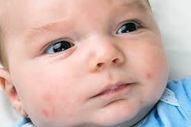They can be put on the skin as ointments, gels, foams, and creams, or they can be injected into skin. Is That Acne On My Baby S Face