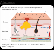 Es wird angenommen, dass zugsalbe die spontanperforation begünstigt. Abszess Hausmittel Abszess Offnen Abszesswunde Pflegen Medica Apotheke Kiel