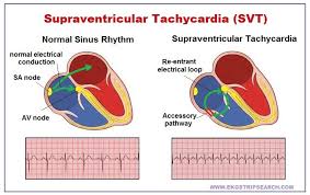 Ekg Strip Search Supraventricular Tachycardia Svt Ekg Ventricular Tachycardia Emergency Room Nurse