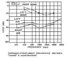 Do you have an audiogram but don't know how to read it? 15 Audiograms Ideas Audiology Audiology Student Hearing Loss