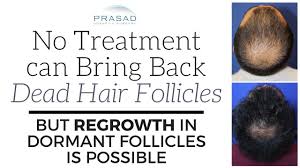 How to repair hair follicles. Why No Treatment Can Revive Dead Hair Follicles But Regrowth Of Dormant Follicles Is Possible Youtube