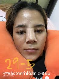 Experience with a great nose at Sowon Clinic