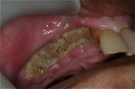 Image result for Bisphosphonates