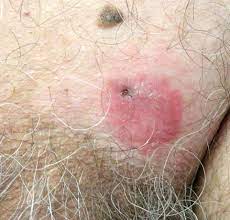 What Is Your Diagnosis Extramammary Paget Disease Mdedge Dermatology