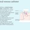 A quick guide to setting up a hemodynamic circuit like an arterial line or a central venous pressure line. Https Encrypted Tbn0 Gstatic Com Images Q Tbn And9gcs2dnybwy5p9cibdfk3l8v7 Ss684catmsm03zluzz6mosgyjhk Usqp Cau