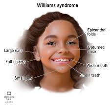 Williams Syndrome, Williams Beuren Syndrome: Causes, Symptoms & Treatment