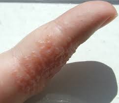 Sverely itchy hands and feet(blood pressure ?) itchy rash all over both shin bones and on forearms and fingers. Dyshidrosis Wikipedia