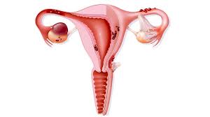 Matokeo ya picha ya image of endometriosis