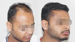 Hair Transplant In Dubai Its Cost Benefits And More Hair Transplant In India Body Hair Transplant Best Hair Transplant